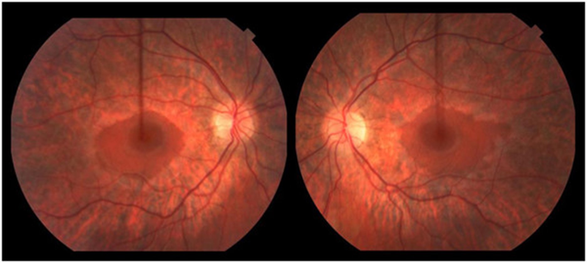 【佳学基因检测】前额高腭弓高囟门增大人中长眼距过宽肌张力减退还有癫痫是不是遗传性DBP缺乏症？